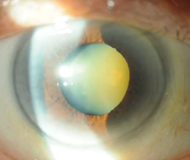 CATARACT