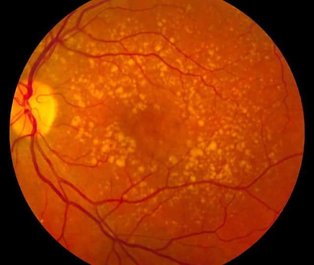 Age-related macula degeneration