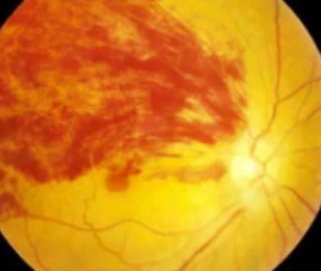 RETINAL DISEASES